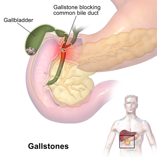 Understanding Gallstones and Cholecystectomy